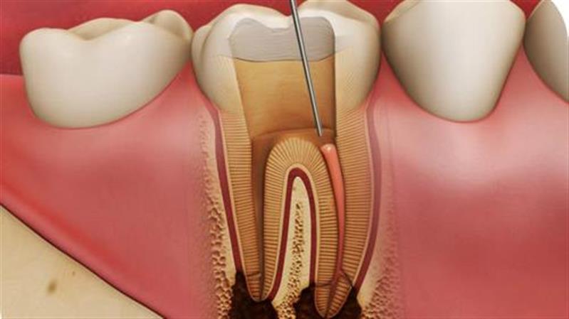 Dental nerve treatment - Skin and Teeth Medical Center - Ajman - UAE
