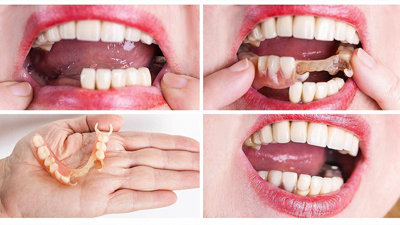 أطقم الأسنان الجزئية - مركز سكن اند تيث الطبي