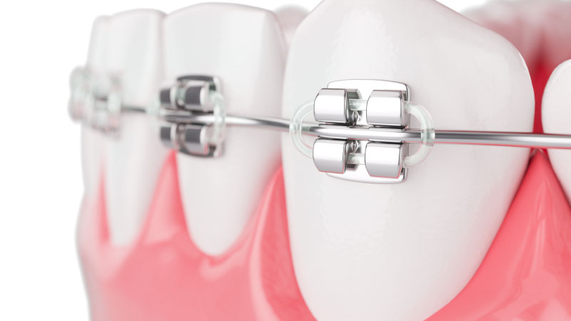 تقويم الأسنان المعدني - مركز سكن اند تيث الطبي