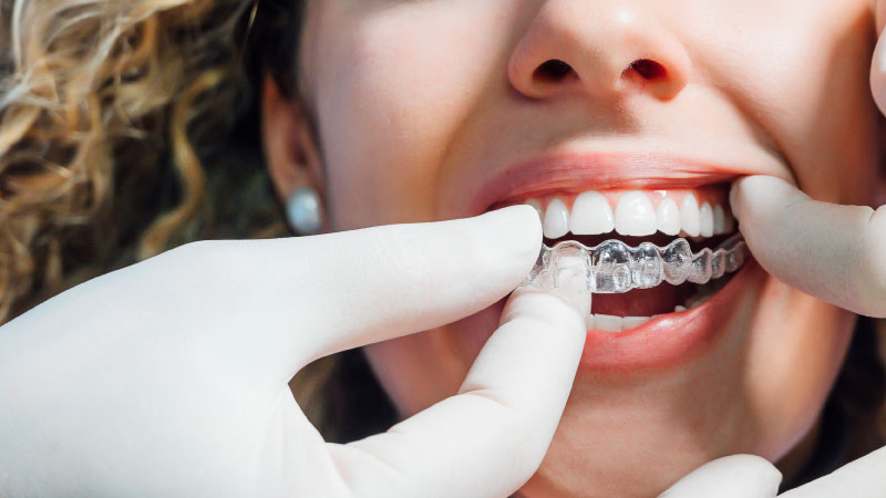 Transparent orthodontics (Invisalign) - Skin and Teeth Medical Center - Ajman - UAE